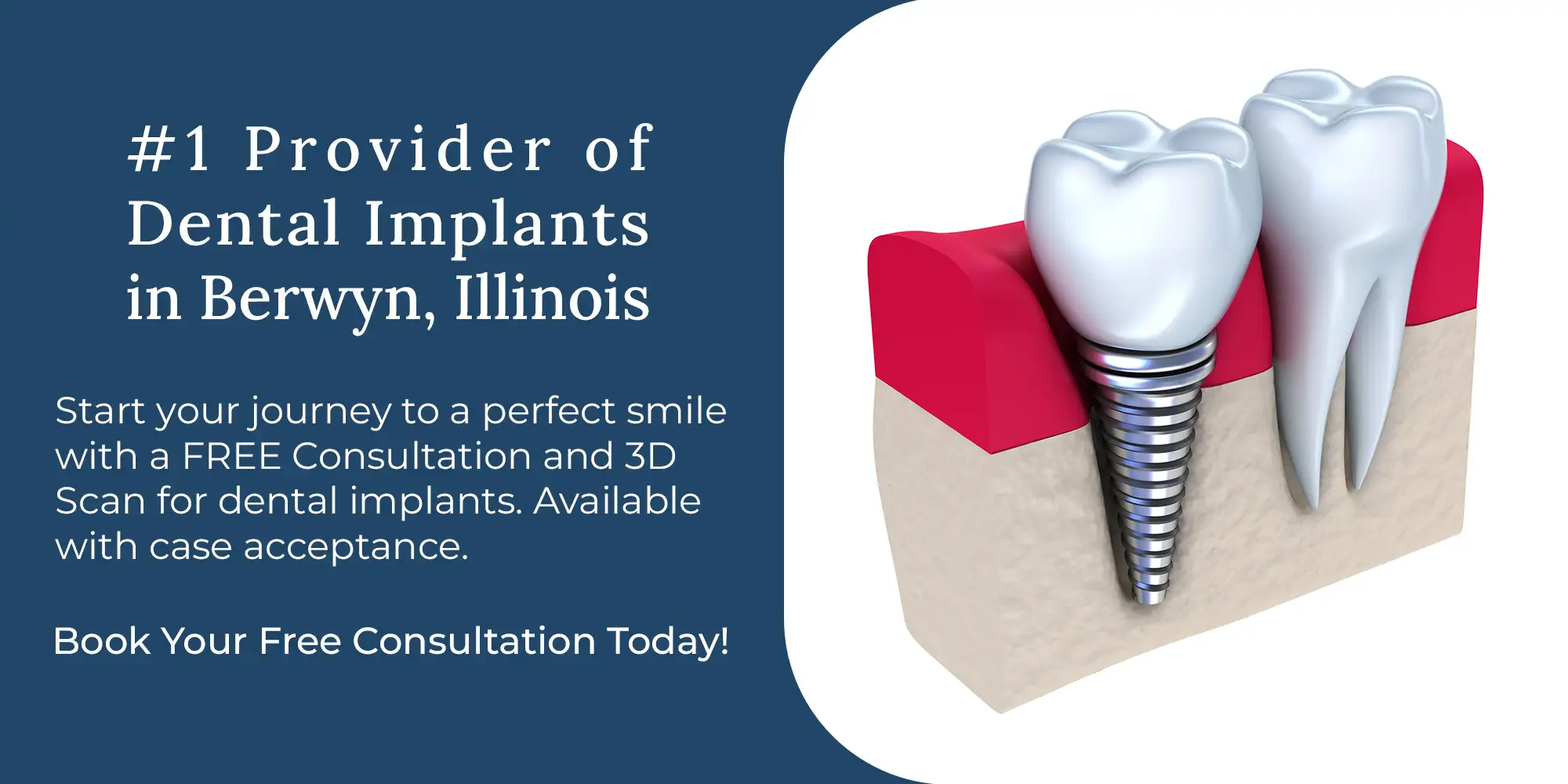 Dental-Implants Dental-Implants